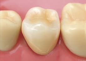 大垣市の歯医者、ビバ・スマイル歯科の詰め物・被せ物治療