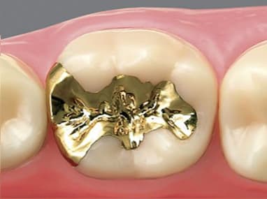 大垣市の歯医者、ビバ・スマイル歯科の詰め物・被せ物治療