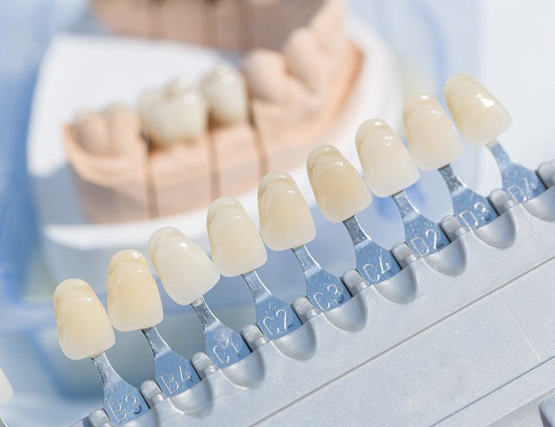 大垣市の歯医者、ビバ・スマイル歯科の審美歯科