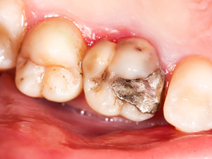 大垣市の歯医者、ビバ・スマイル歯科の金属アレルギー歯科治療