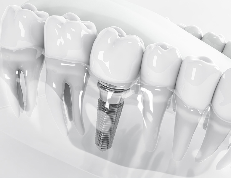 大垣市の歯医者、ビバ・スマイル歯科のインプラント治療