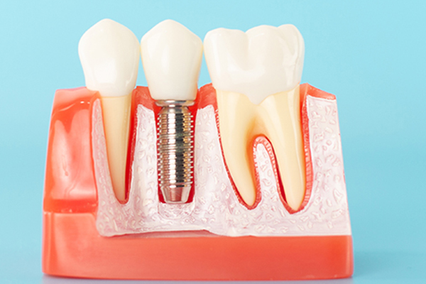 大垣市の歯医者、ビバ・スマイル歯科のインプラント