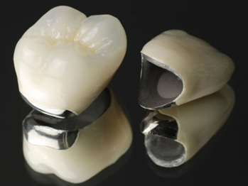 大垣市の歯医者、ビバ・スマイル歯科の詰め物・被せ物治療