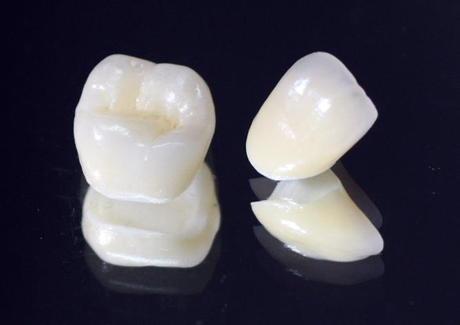 大垣市の歯医者、ビバ・スマイル歯科の詰め物・被せ物治療